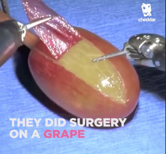 Tilstand Foran radikal They Did Surgery on a Grape" Meme Began With Legally Suspect Medical Tool