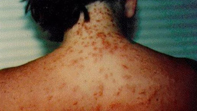 Sea lice can leave hundreds of tiny stings on a swimmer's body.