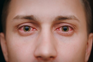 eye infection