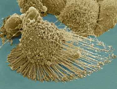 Title: HeLa-IV Description: Scanning electron micrograph of an apoptotic HeLa cell. Zeiss Merlin HR-...