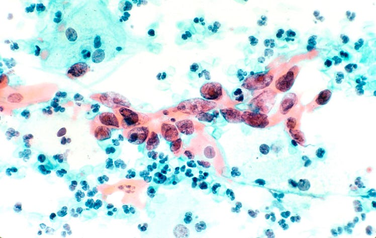 cervical cancer cells