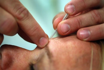 acupuncture forehead hands needle