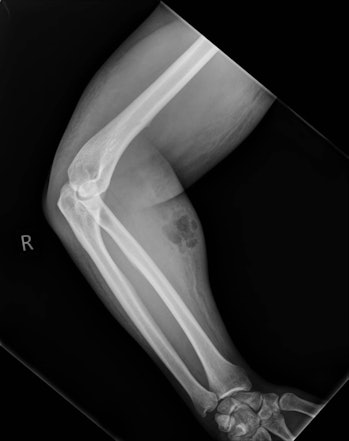 x ray, semen arm