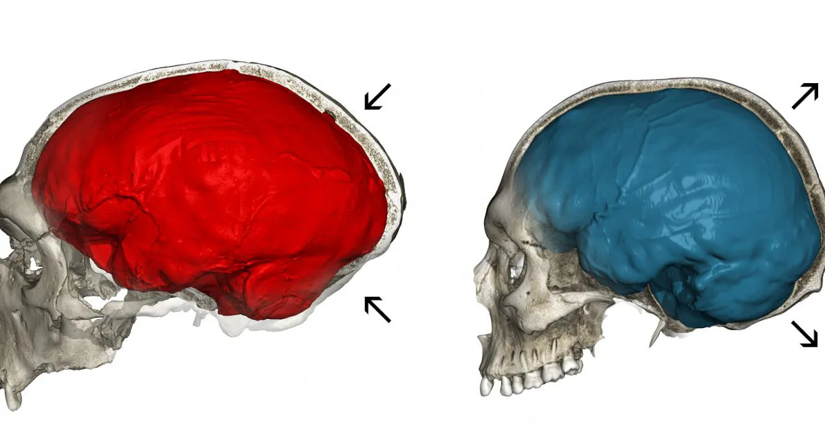 Neanderthal Genes Explain the Roundness of Modern Human Brains