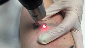 How Does Laser Tattoo Removal Work? It Hurts, But It's ...