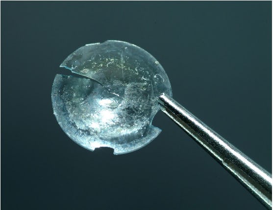 UK Woman Had Contact Lens Lodged in Her Eye for 28 Years