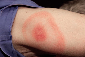tick rash lyme disease
