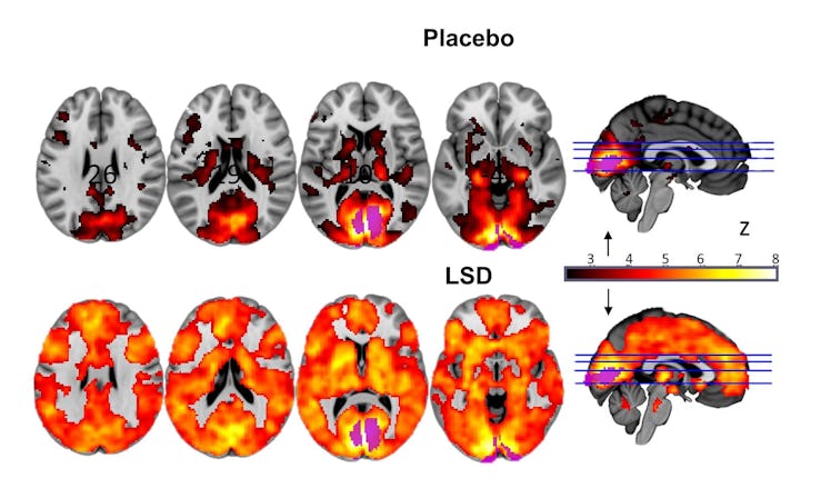 brains, LSD