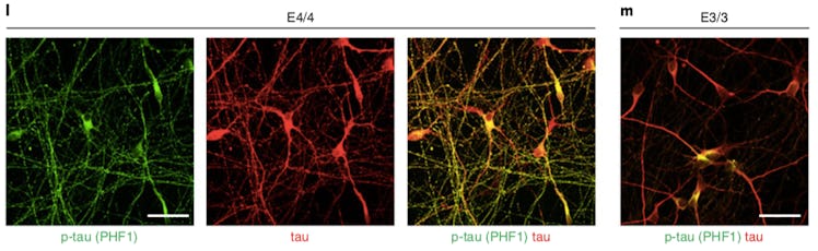The three images on the left show cultured human neurons that express ApoE4. You can see the greater...