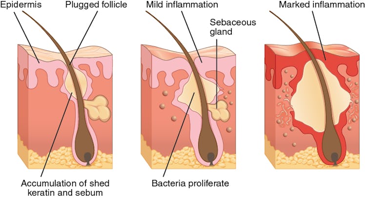 acne, pimples