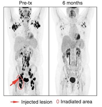 One patient's PET scans show just how significant the reduction in tumors was six months after treat...