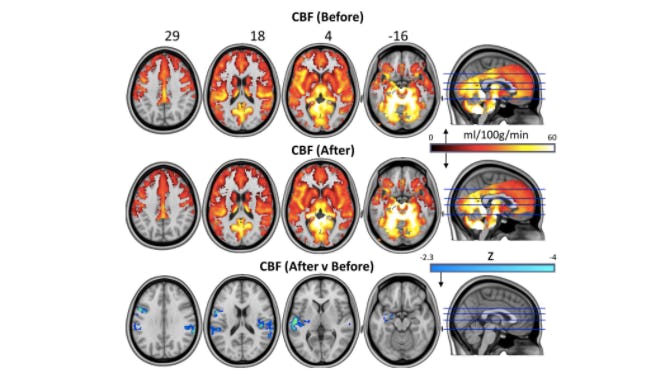 Magic Mushrooms Hit Brain's 'Reset' Button In Depressed Patients