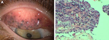 eyes ophthalmology eye injury eye disease