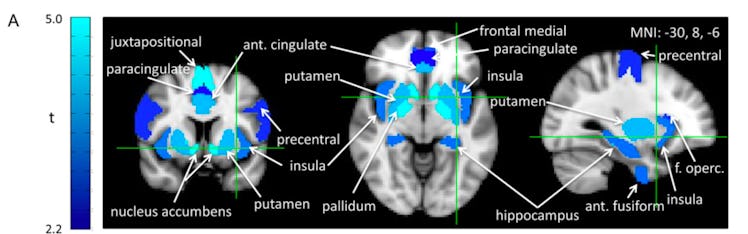 brain scans group bias