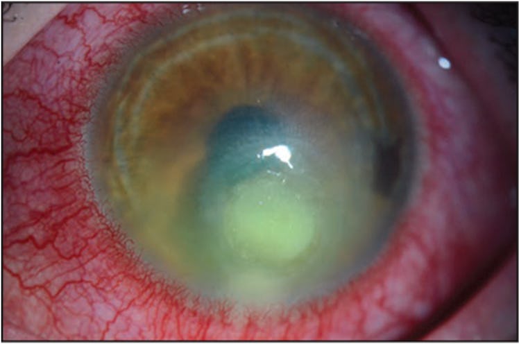 Closeup of an eye with corneal infection