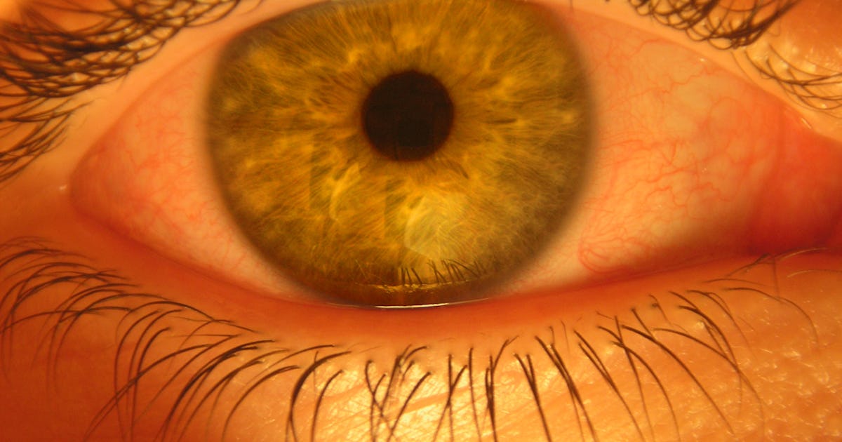 Why Do Eyes Swell With Allergies? Redness and Itching is Part of the Battle