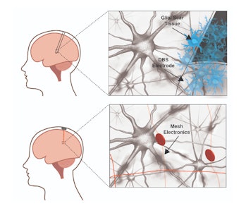 A traditional neural electrode (top panel) provokes an immune response in the brain while a mesh ele...