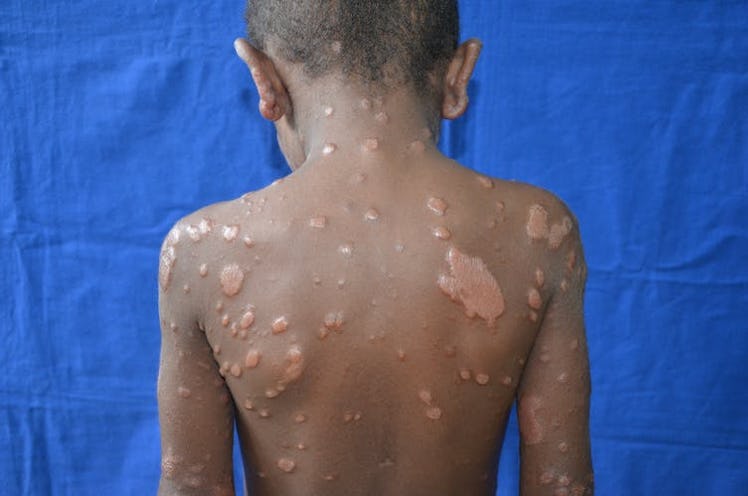 Severe leprosy case with many lesions in a year-old-child in Brazil.