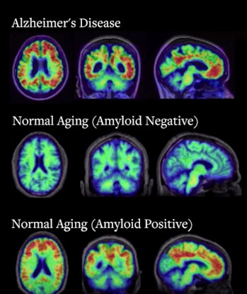 pet scan alzheimers