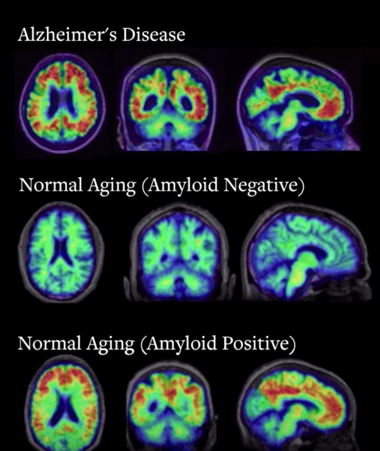 pet scan alzheimers