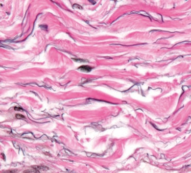 Collagen fibers support the fluid-filled channels that make up the interstitium.