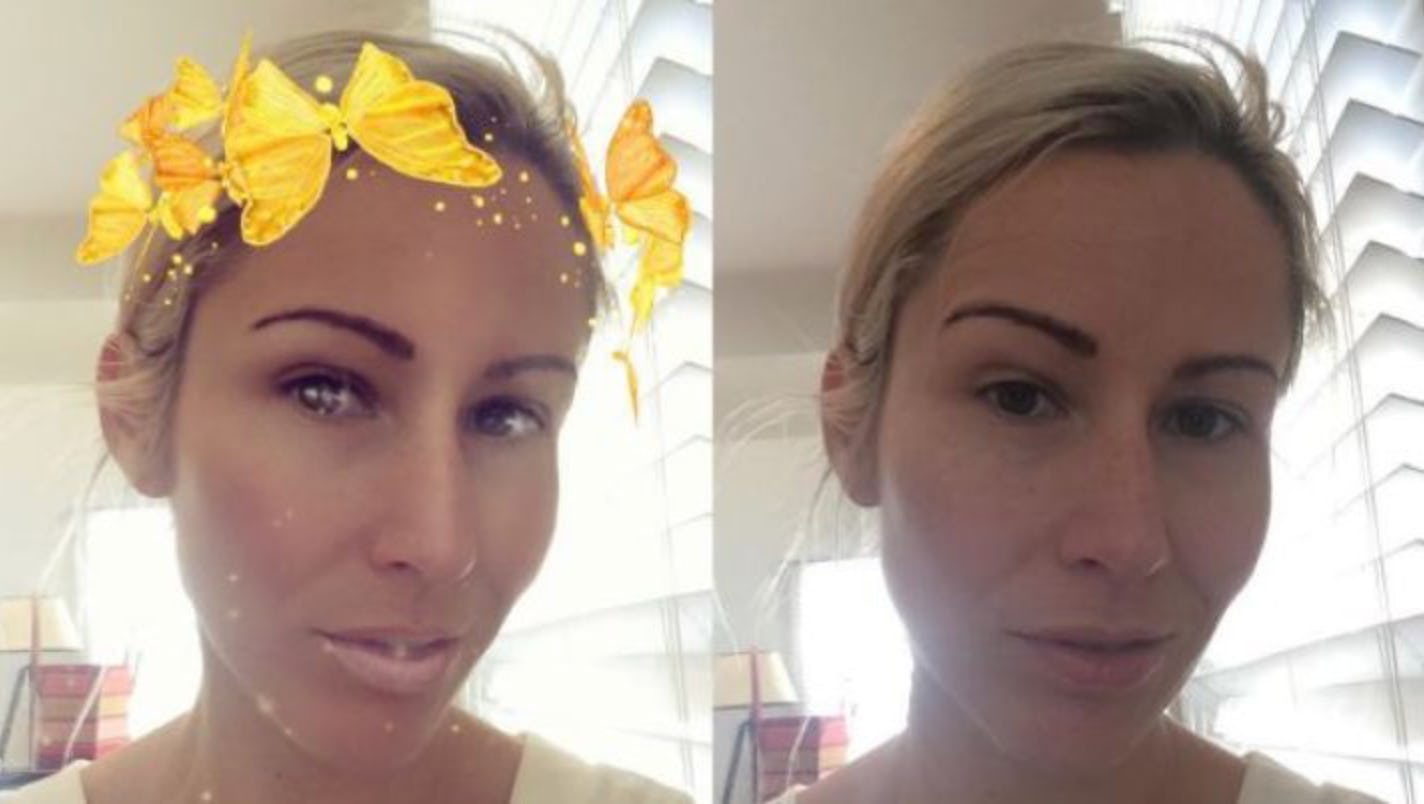 Snapchat Dysmorphia Plastic Surgeons Are Concerned About Effect of Filters