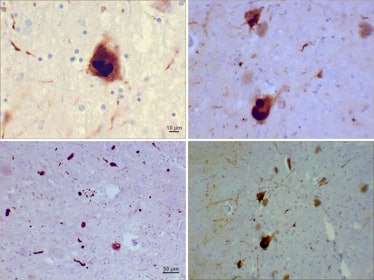 Lewy bodies (alpha synuclein inclusions)