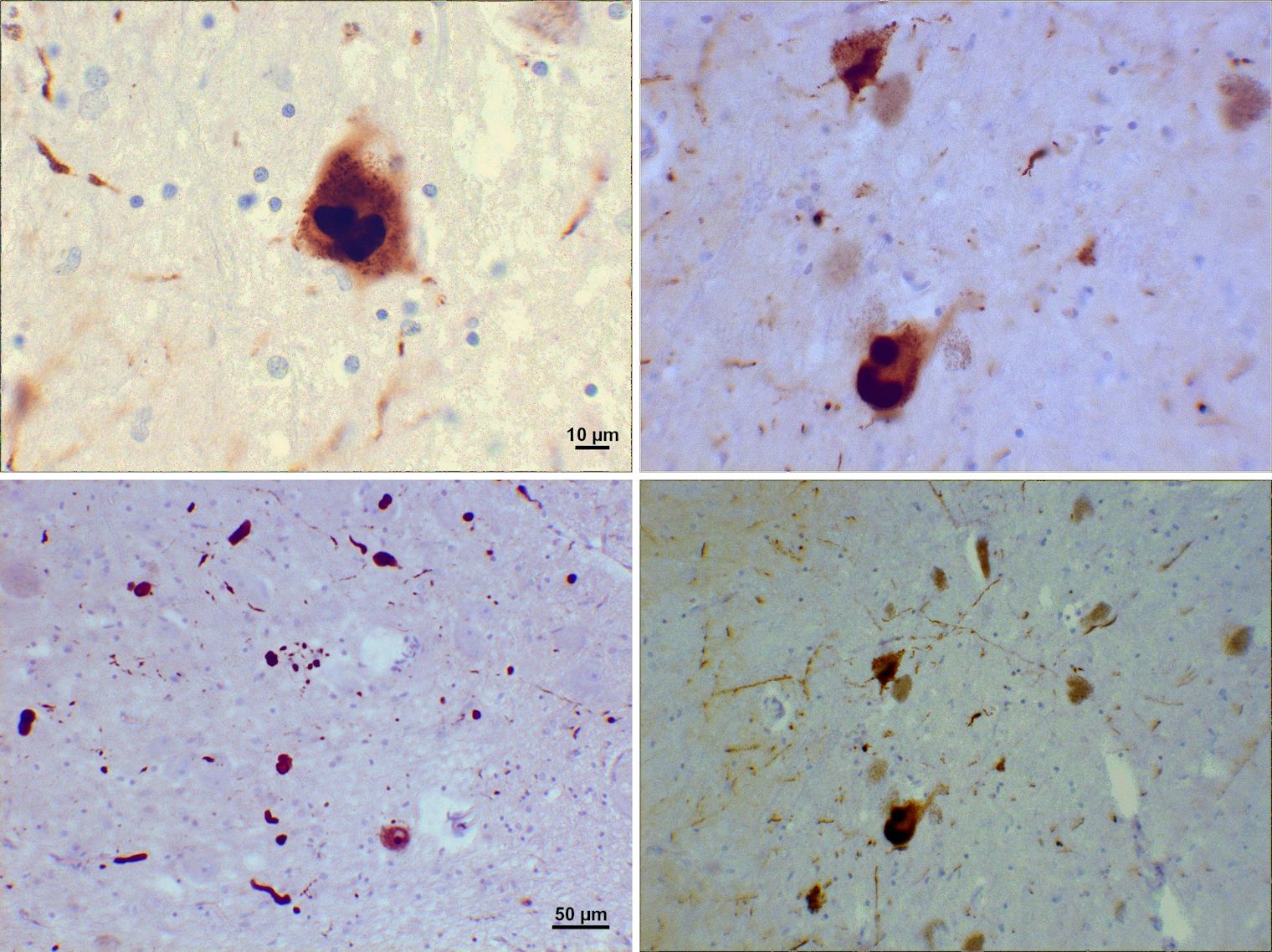 What is Lewy Body Disease? The New Condition Linked to Football Injuries