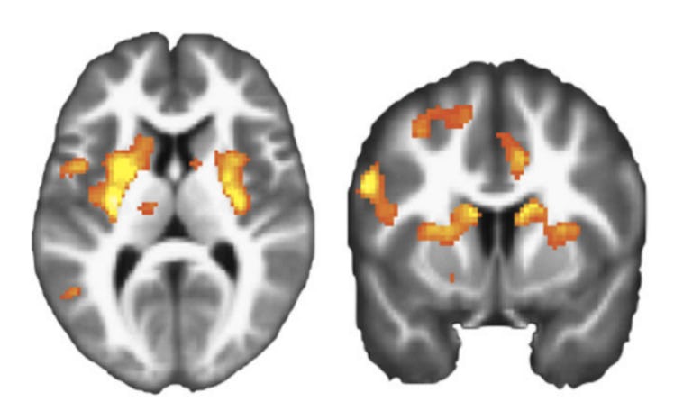 fMRI of dorsal striata