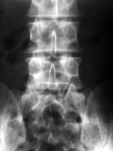 An x-ray of a human lumbar spine. This view shows the fourth and fifth lumbar vertebrae, as well as ...
