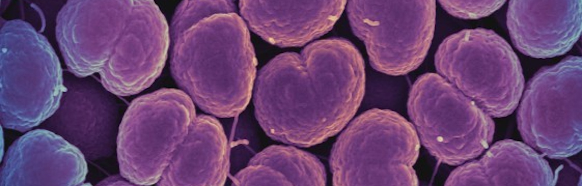 Untreatable gonorrhea: How worried should we be? - Daily 