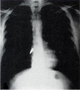 X-ray of a bullet in the heart.