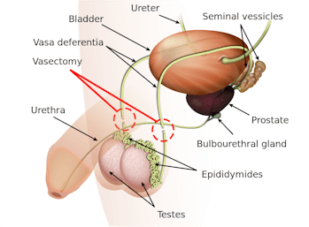 vasectomy