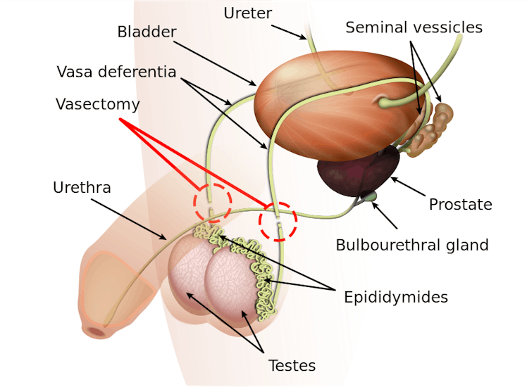 vasectomy