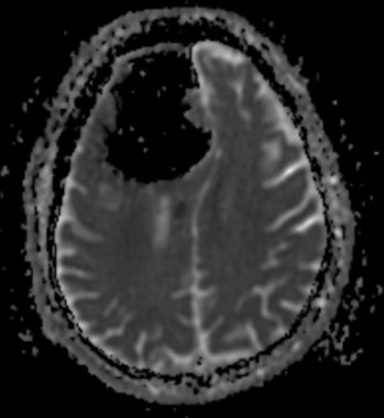 brain scan air pocket
