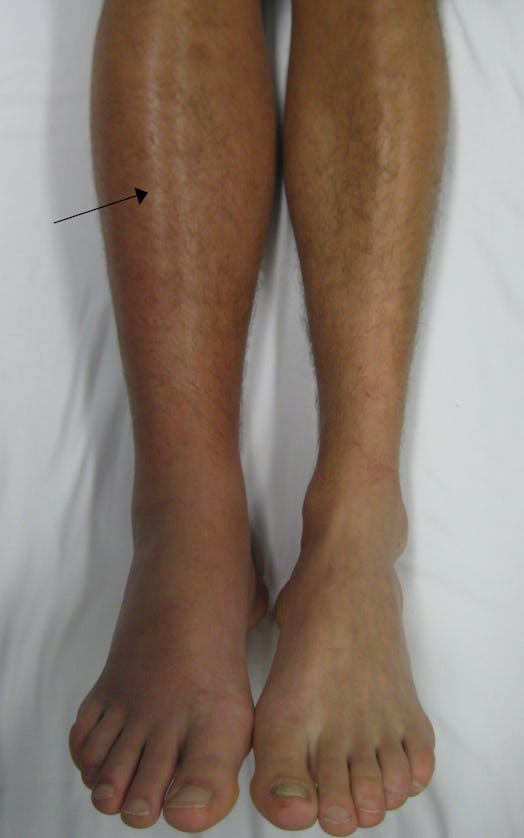 A deep vein thrombosis as seen in the right leg is a risk factor for pulmonary embolism