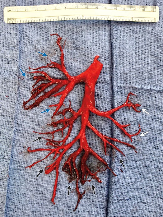 Red right bronchial tree