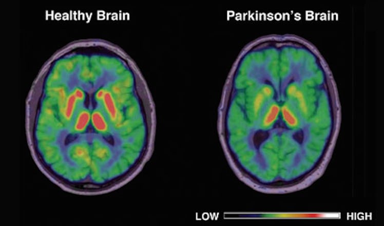 Illustration that is showing differences between healthy and Parkinson's brain