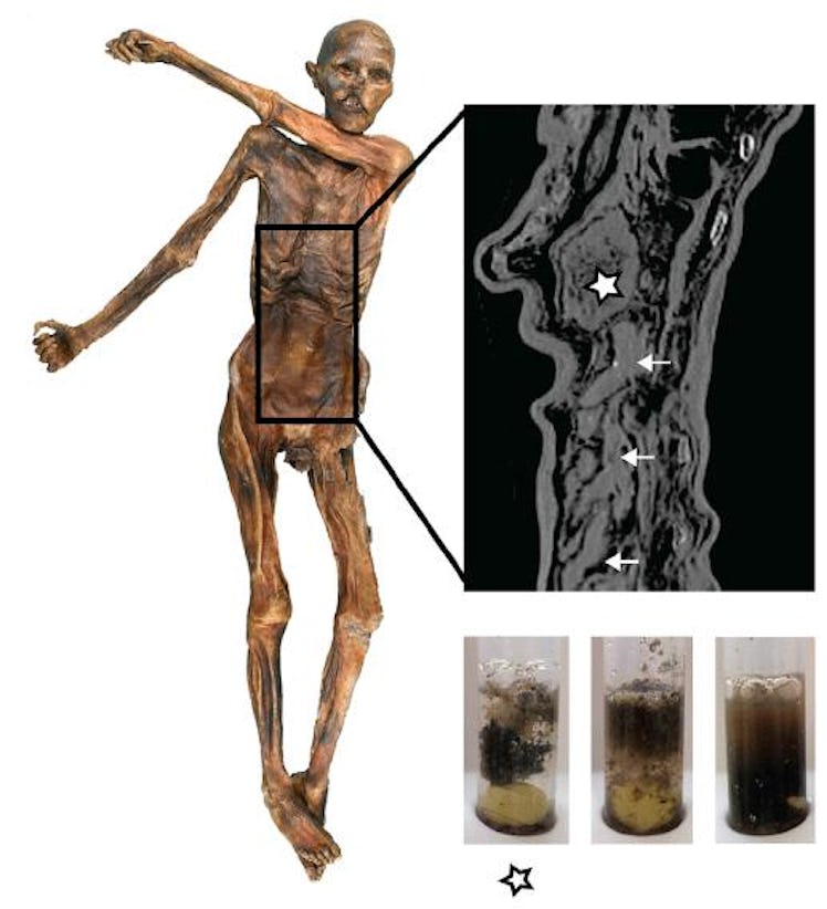 Ötzi's gastrointestinal (GI) tract preservation and content texture. The radiographic image shows th...