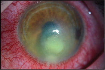 corneal infection