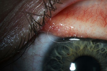 Here's the small T. gulosa worm in Abby Beckley's conjunctiva.