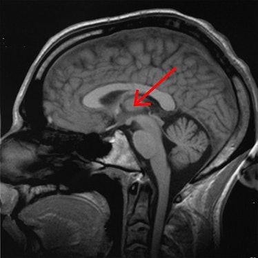 thalamus brain