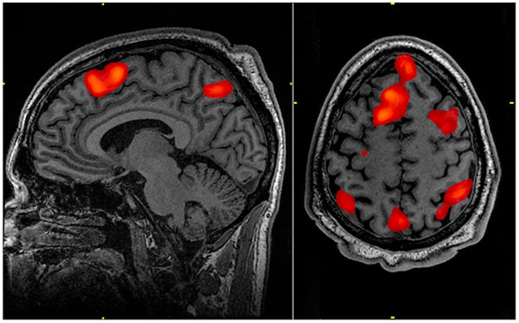 mri scan