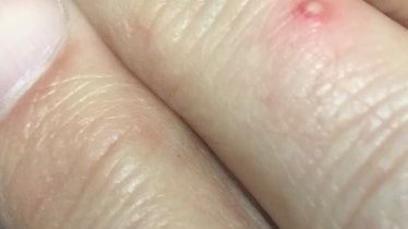 Pustule from Fire Ant bite