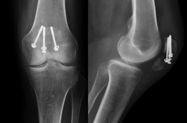 patellar fracture surgery screws x-ray