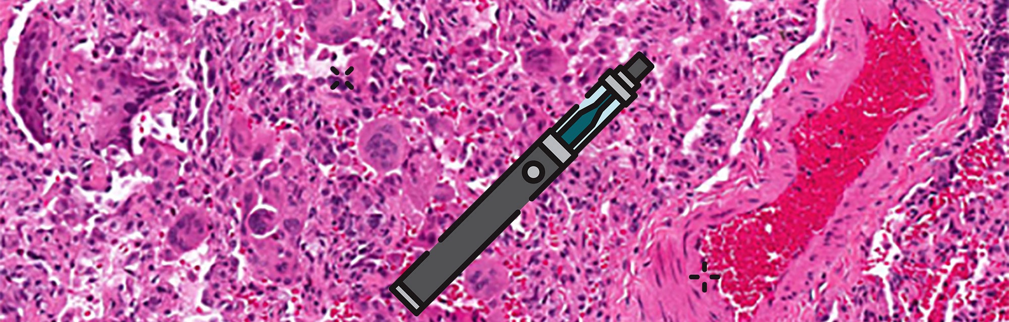 Marijuana Vape Users Are Getting Incurable Quot Cobalt Lung Quot