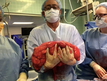 Dr. Julio Teixeira holds Daly's 30-pound tumor like a gigantic newborn baby.