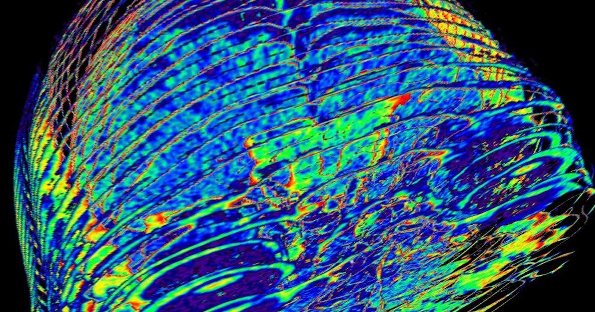 LSD Causes Brain Connectome to Reorganize in New Psychedelic Study