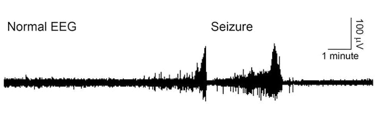 The pattern of typical brain activity is very regular. During an epileptic seizure, the electrical a...