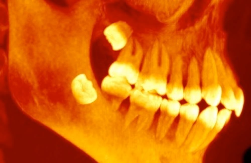 Why Do Humans Still Have Wisdom Teeth? Evolution Explains